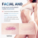 Lanthome scar removal cream